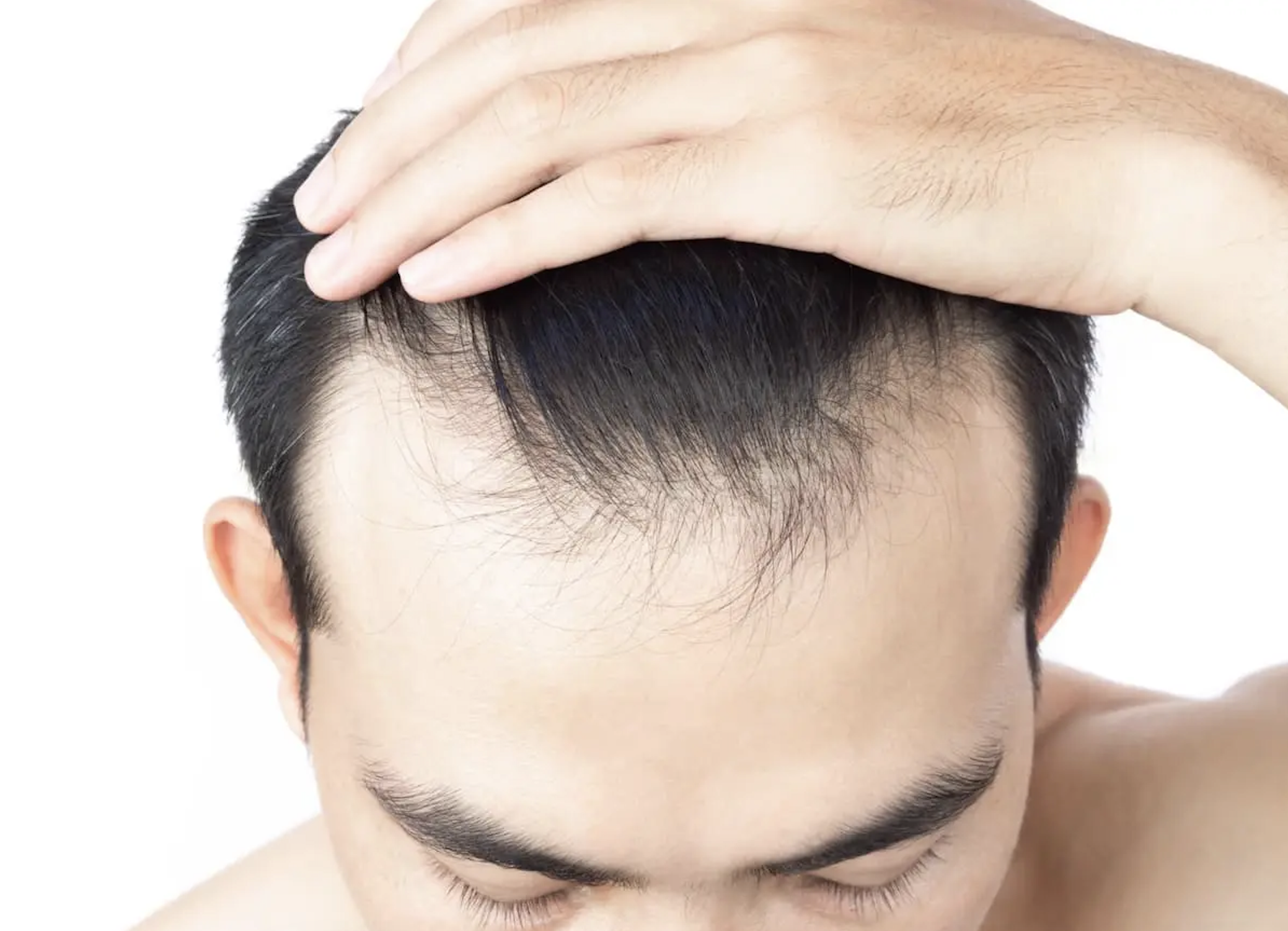 Hair Loss - image 1