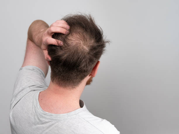 Hair Loss - image 2