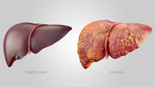 Liver Disease - image 1