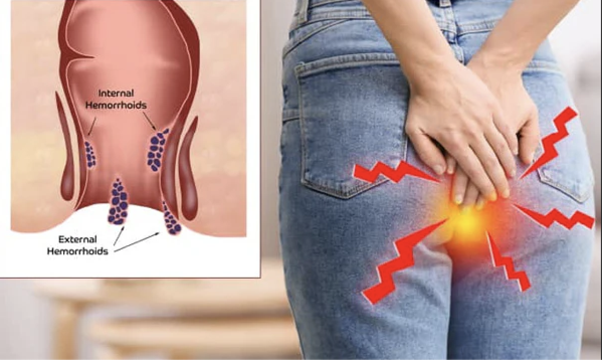 Piles (Hemorrhoids) - image 1