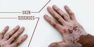 Skin Diseases